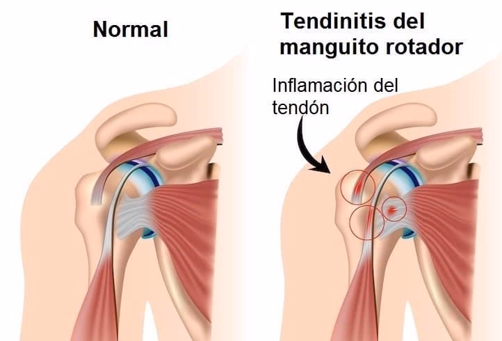 ¿Qué actividad laboral puede causar tendinitis en el hombro?
